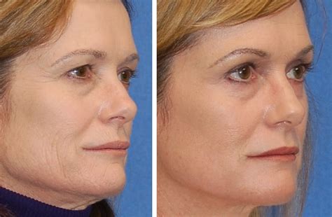 Sciton® Erbium Laser Skin Resurfacing Napa Solano Plastic Surgery