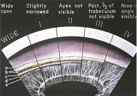 Gonioscopy 3: Grading Systems, Normal Variations & Abnormalities ...