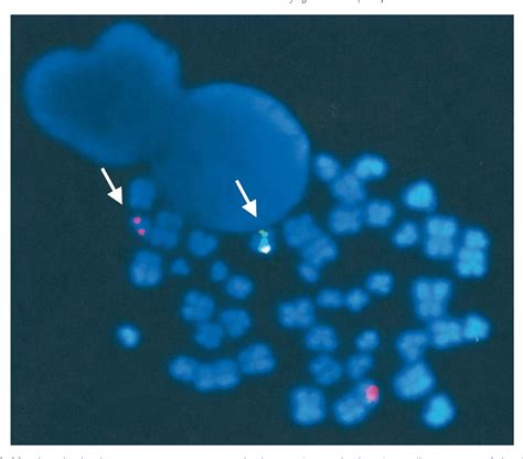 [pdf] Variant Acute Promyelocytic Leukemia Translocation 15 17 Originating From Two Subsequent