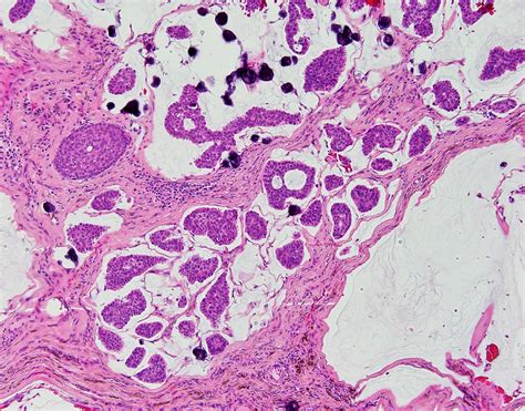 Primary Cutaneous Mucinous Carcinoma | Global Pathology Teaching and ...