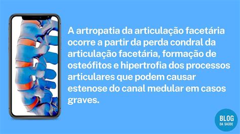 Artrose Interfacetária O Que é E Como Tratar Blog Da Saúde