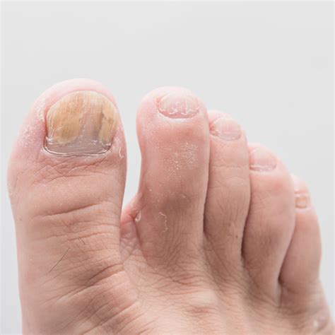 Diabetic Toenails Turning White Bios Pics