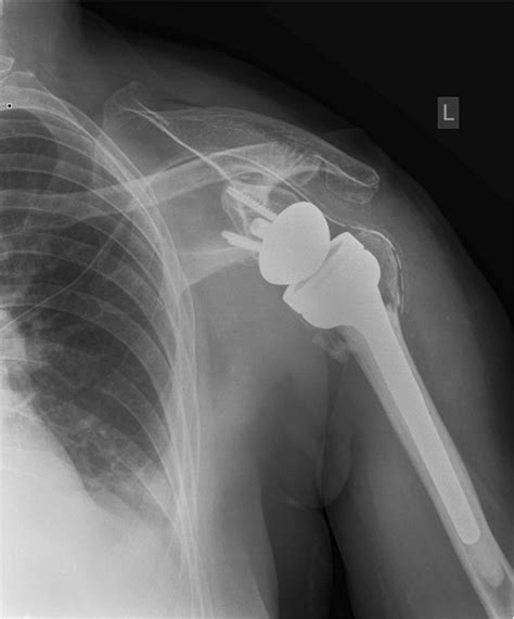 X Ray After Implantation Of Reverse Shoulder Arthroplasty With