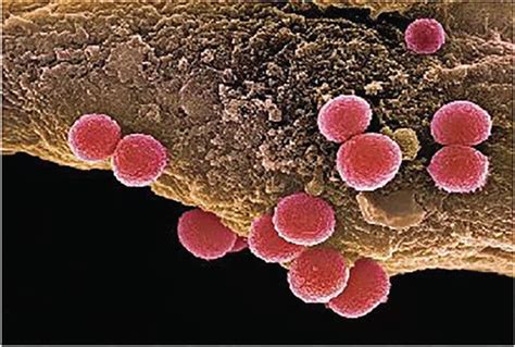 Staphylococcus Aureus Cellulitis