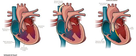 Tetralogy Of Fallot Diagnosis And Treatment