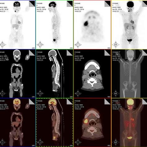 Representative Fusion Positron Emission Tomography Computed Tomography