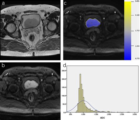 Muscle Invasive Papillary Urothelial Carcinoma In The Posterior Bladder