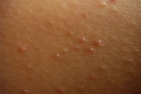 Bumps On Arms Keratosis Pilaris Causes And Treatments