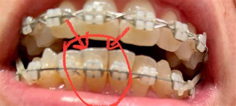 Grey Spots On Teeth R Braces