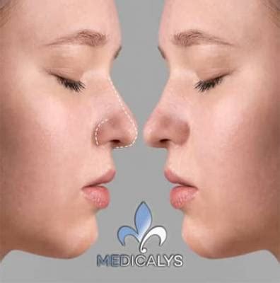 Rhinoplastie primaire sec et tertiaire La différence Medicalys