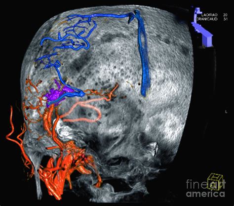 Arterial Malformation Photograph By Zephyr Science Photo Library Fine