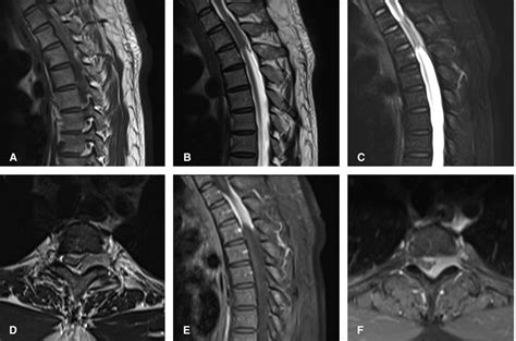 Frontiers Case Report Upper Thoracic Purely Extradural Spinal