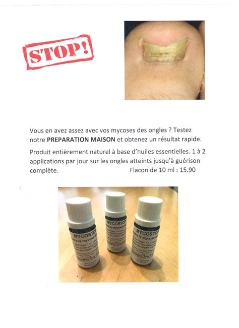 NOUVELLE PREPARATION MAISON CONTRE LES MYCOSES DES ONGLES