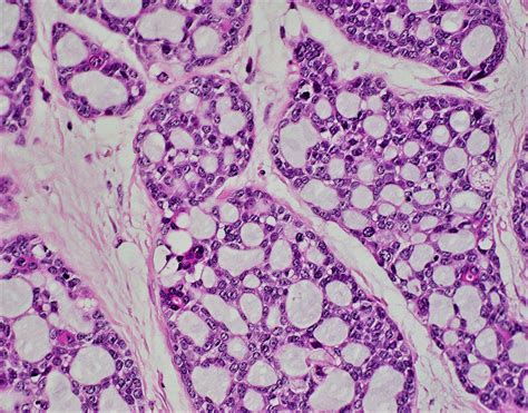 Adenoid Cystic Carcinoma Breast Low Grade Bosnianpathology