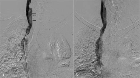 Superior Vena Cava Svc Stenting A Right Internal Jugular Venogram