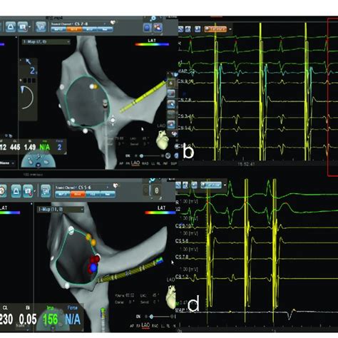 Zero Fluoroscopy Radiofrequency Ablation For AVNRT A Modeling Of The