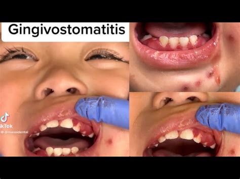 Herpetic Gingivostomatitis Gums