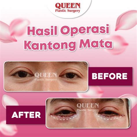 Manfaat Blepharoplasty Untuk Ptosis Pada Kelopak Mata - Klinik Bedah ...