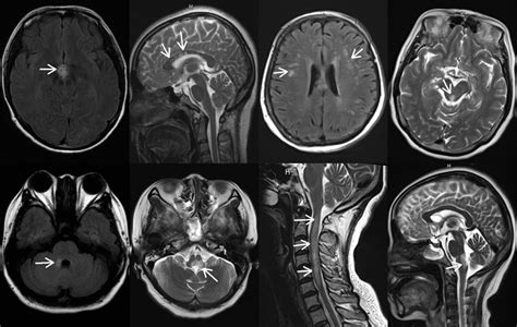 Representative Magnetic Resonance Imaging Abnormalities Arrows In