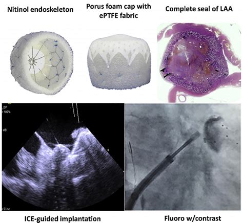 B Po Intracardiac Echocardiography Guided Implantation Of A