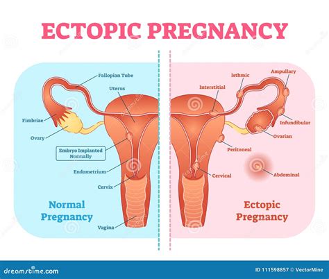 Ectopic Pregnancy Or Tubal Pregnancy Medical Diagram With Female