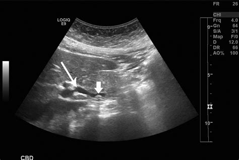 Gallbladder Dysfunction Cholecystitis Choledocholithiasis Cholangitis And Biliary Dyskinesia