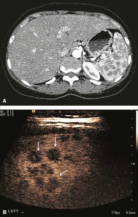 SciELO Brasil Common And Uncommon Features Of Focal Splenic Lesions