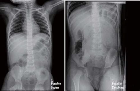 Point Of Care Ultrasound Identification Of Pneumatosis Intestinalis