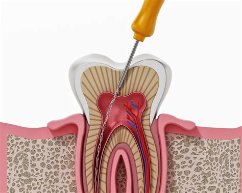 Endodontiste à Nice on vous conseille