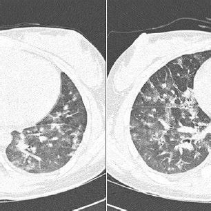 Chest CT Scan Shows Patchy Air Space Opacities And Diffuse Ground Glass