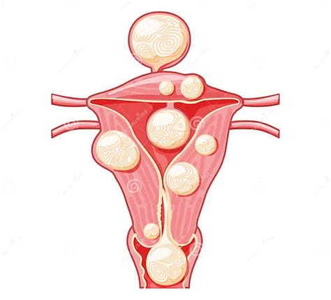 Set Of Uterine Fibroids Female Leiomyomas Reproductive System Uterus In