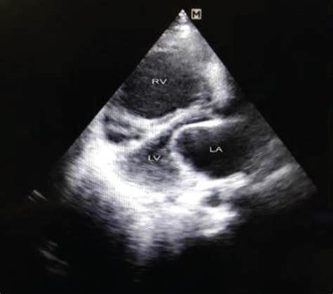 Plax View 2d Echocardiogram Picture Showing Dilated Rv And Restricted