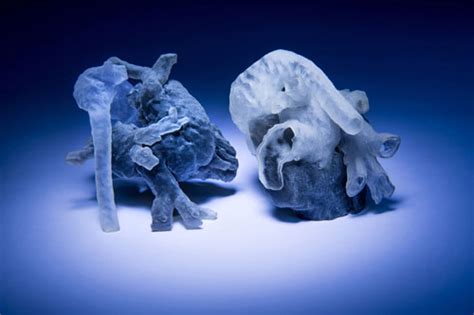 Personalized 3d Printed Heart Models For Surgical Planning