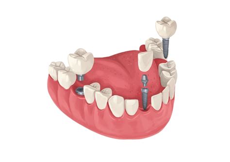 What Insurance Covers Dental Implants Authority Dental