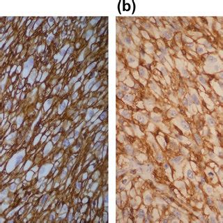 A B Membranous And Cytoplasmic Positive For CD44s Expression In