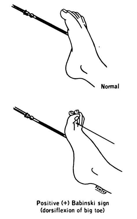 Upper Motor Neurone Function Clinical Relevance Teachmephysiology