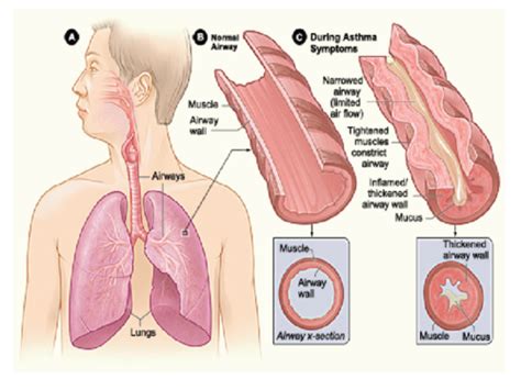 Lecture Treatment Of Asthma Flashcards Quizlet