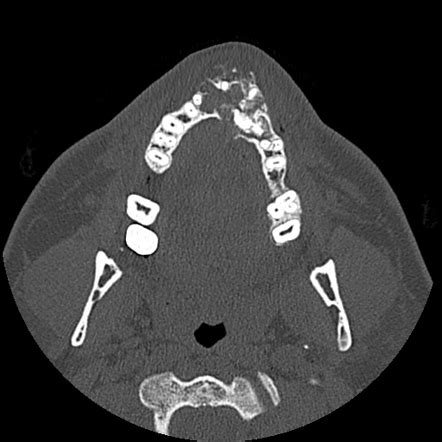 Calcifying Epithelial Odontogenic Tumor Image Radiopaedia Org