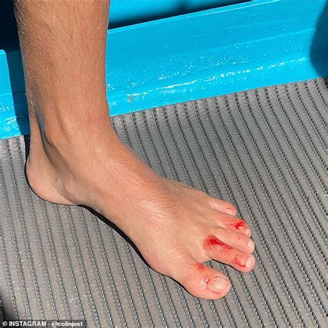 Colin Jost Shows Off Nasty Foot Injury From Olympics In Tahiti With Snl