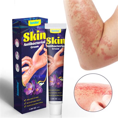 Sumifun Antibacterial Cream Psoriasis Dermatitis Eczema Treatment Cream