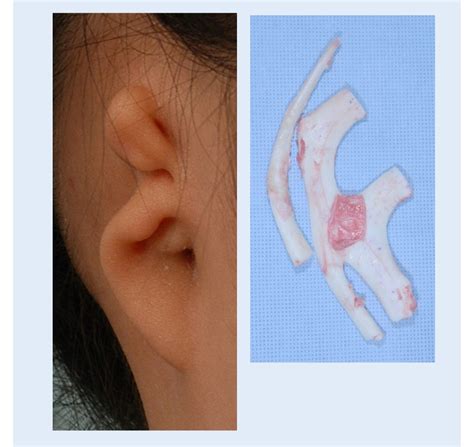 12 Year Old Girl S Right Microtia Reconstructed Ear Surgery Korea