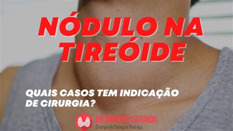 Nódulo na tireóide Quais casos tem que operar YouTube