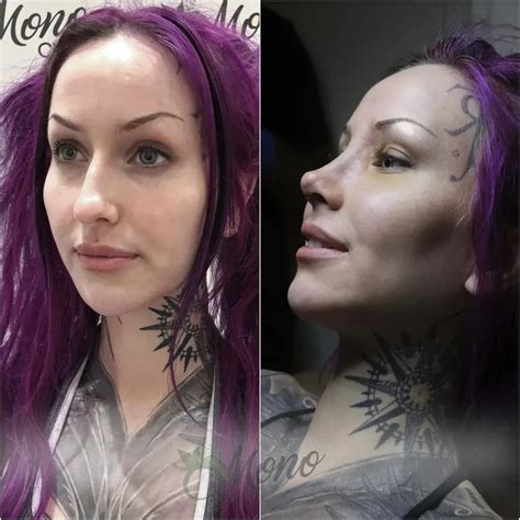 Shelly Dinferno Shellydinfernos Rhinoplasty Journey At Clinic Mono