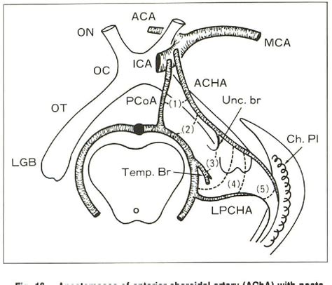 Anterior Choroidal Artery Cta