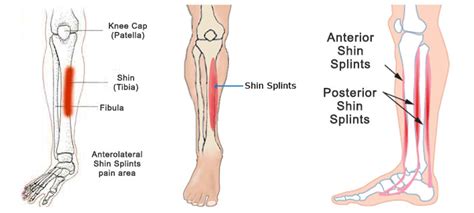 Shin Splints GoFysio Actieve Therapie Voor Jong En Oud