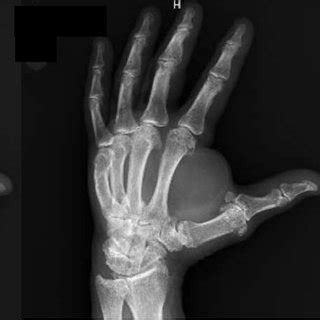 Radiographs Of The Left Hand Reveal A Large Soft Tissue Mass Most