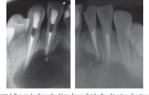 Figure 3 From Decompression Of A Large Periapical Lesion A Case Report