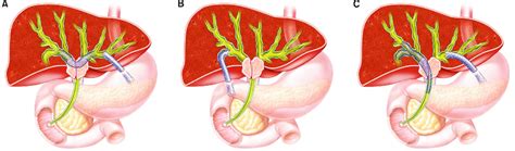 Endoscopic Ultrasound Eus Guided Biliary Drainage Methods For