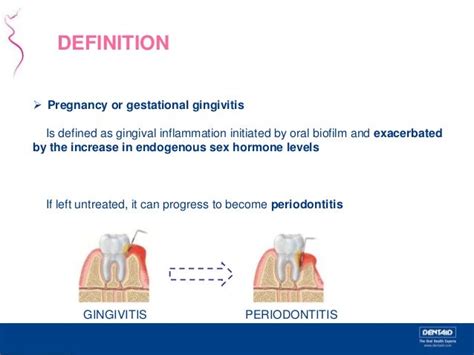 Periodontal Disease And Pregnancy