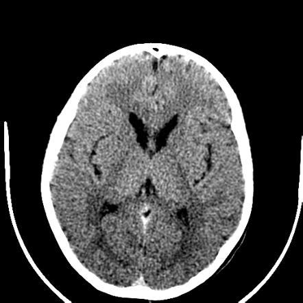 Huntington Disease Juvenile Radiology Case Radiopaedia Org